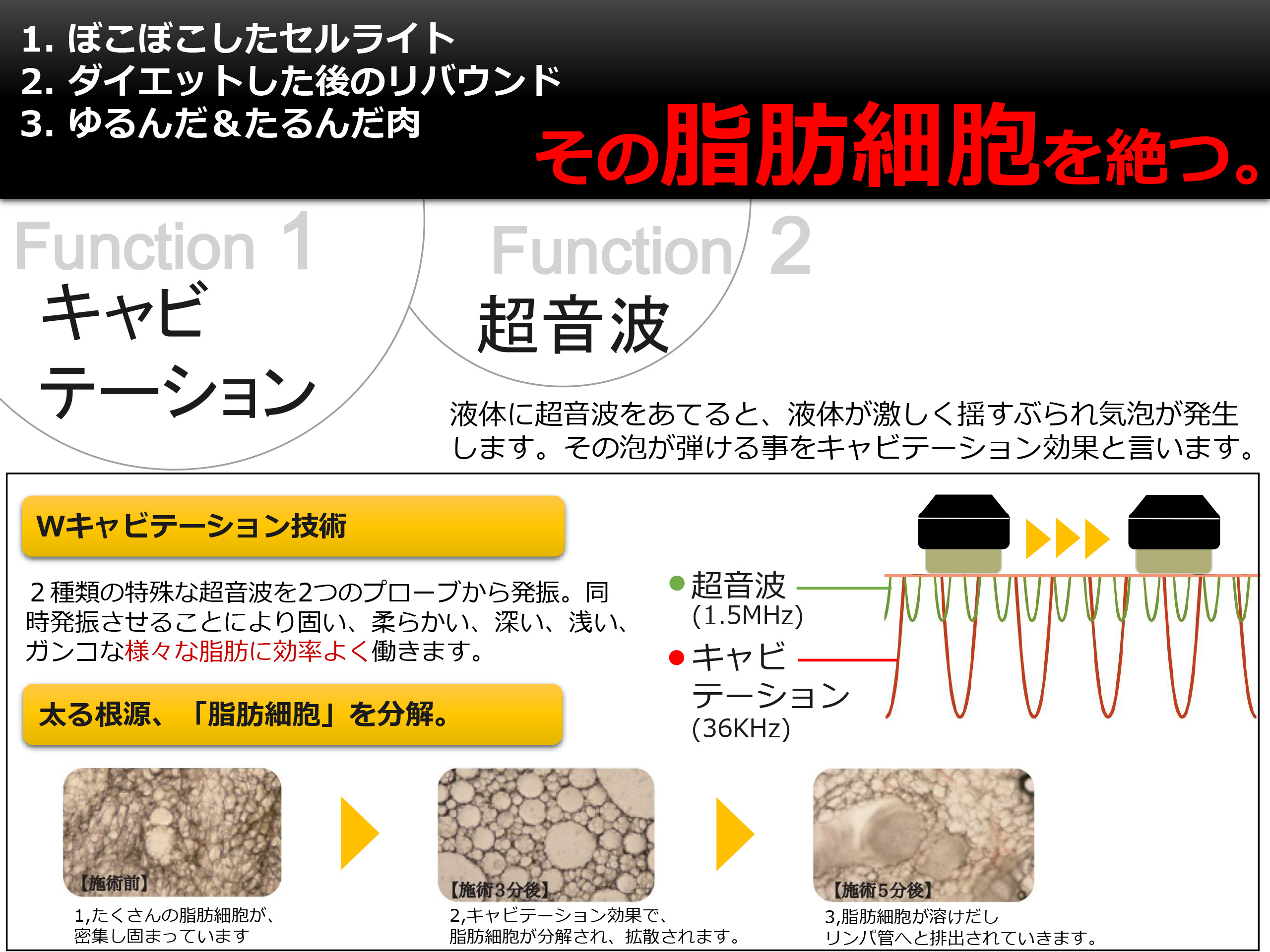 Wキャビテーション技術で、その脂肪細胞を絶つ